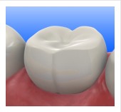 Tooth-Colored Fillings | Fort Worth TX