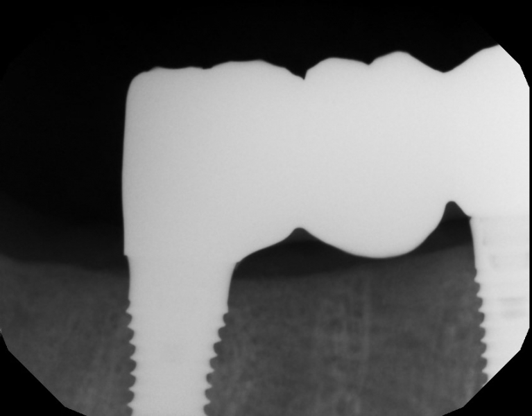 Implant v bridge